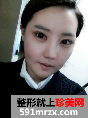 隆鼻割双眼皮恢复图 2个月恢复经历分享