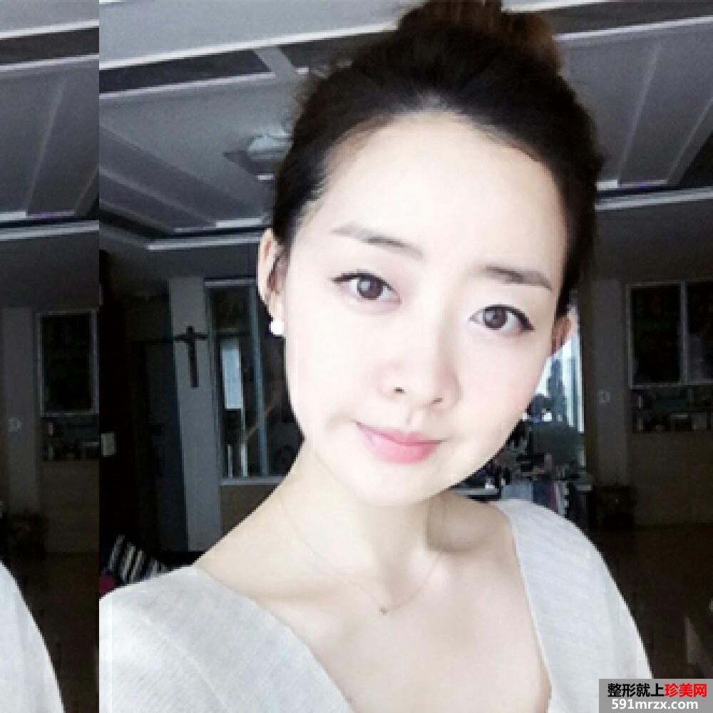 妹子颧骨颧弓内推手术恢复过程分享，还有前后对比效果图片哦！
