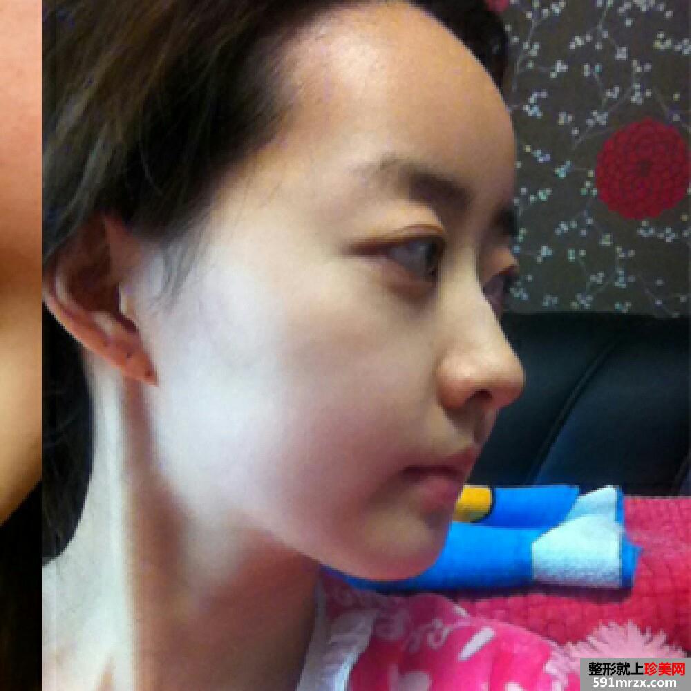 妹子颧骨颧弓内推手术恢复过程分享，还有前后对比效果图片哦！
