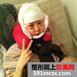 妹子颧骨颧弓内推手术恢复过程分享，还有前后对比效果图片哦！