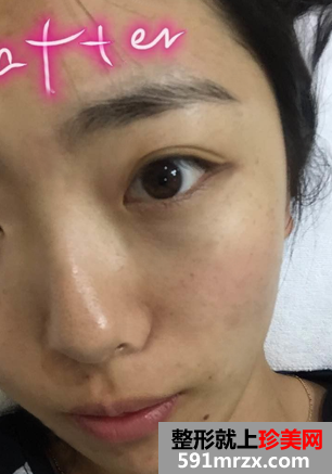 做完光子嫩肤恢复图片