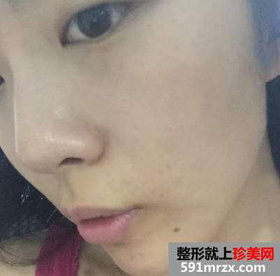 做完光子嫩肤恢复图片