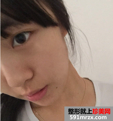 做完光子嫩肤恢复图片