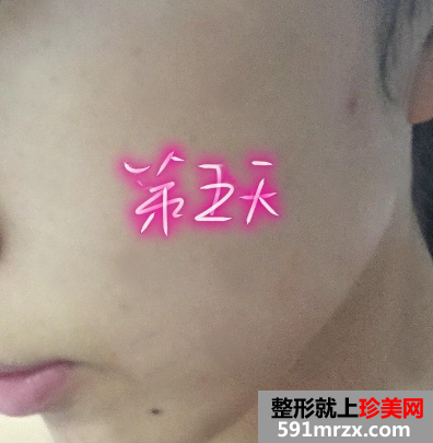 做完光子嫩肤恢复图片