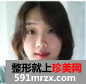 双鄂整形+综合隆鼻术后恢复日记