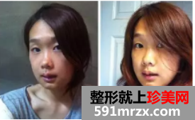 双鄂整形+综合隆鼻术后恢复日记