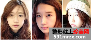 双鄂整形+综合隆鼻术后恢复日记