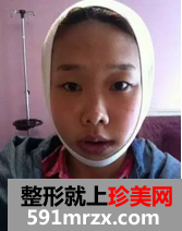 双鄂整形+综合隆鼻术后恢复日记