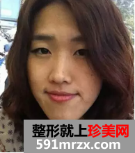 双鄂整形+综合隆鼻术后恢复日记