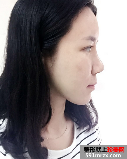 关于自体耳软骨隆鼻前后对比效果图片和恢复过程