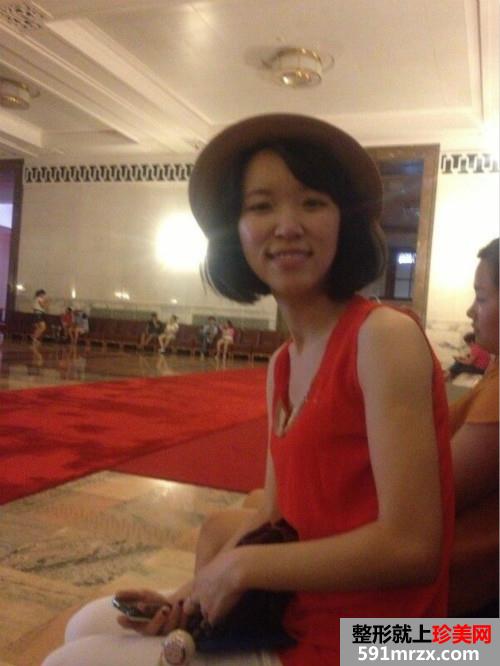 关于自体耳软骨隆鼻前后对比效果图片和恢复过程