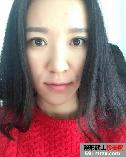 关于自体耳软骨隆鼻前后对比效果图片和恢复过程
