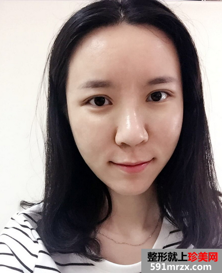 关于自体耳软骨隆鼻前后对比效果图片和恢复过程