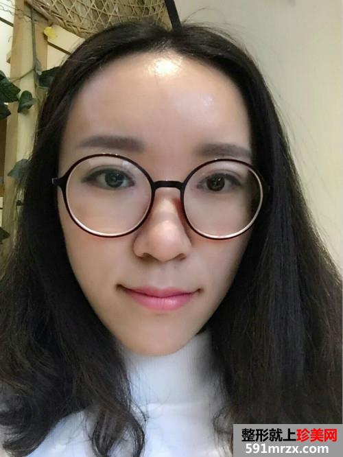 关于自体耳软骨隆鼻前后对比效果图片和恢复过程