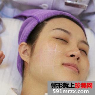 超声刀美容前后照片 北京叶子超声刀案例分享