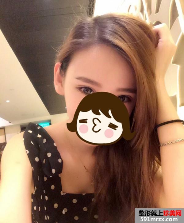 北京马梅生做的面部吸脂 效果非常好哦