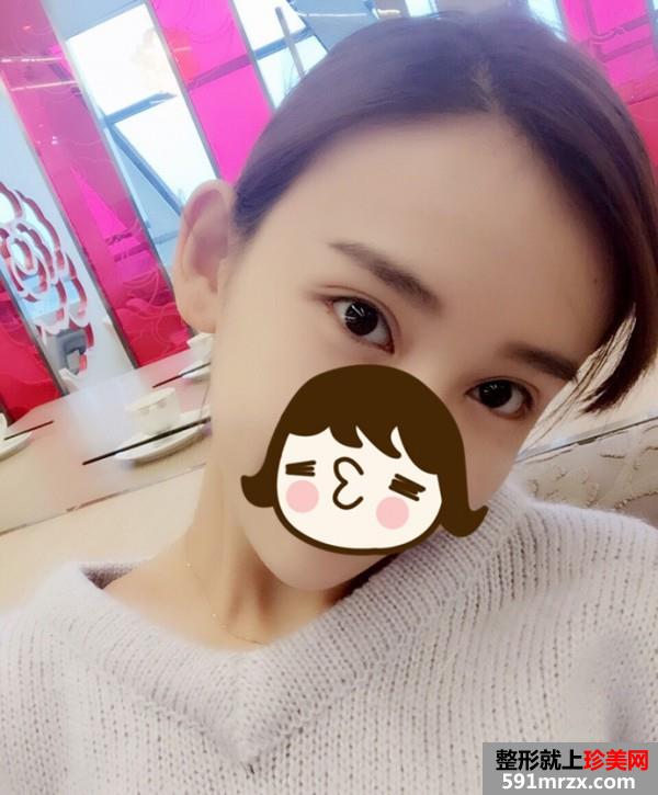 北京马梅生做的面部吸脂 效果非常好哦