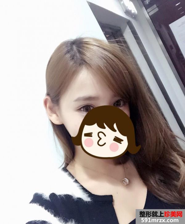 北京马梅生做的面部吸脂 效果非常好哦