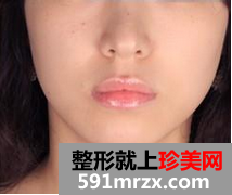 水光针效果图前后对比 告别大饼脸