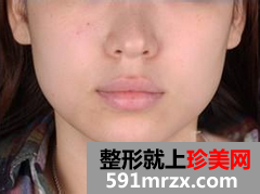 水光针效果图前后对比 告别大饼脸