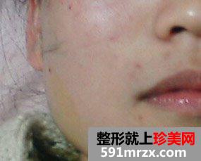 水光针效果图前后对比 告别大饼脸
