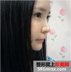 成都华博整形医院注射海薇玻尿酸半年了 快来看看效果