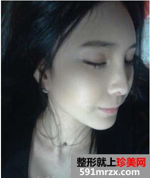 成都华博整形医院注射海薇玻尿酸半年了 快来看看效果