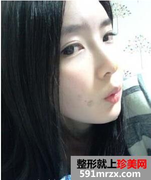 成都华博整形医院注射海薇玻尿酸半年了 快来看看效果