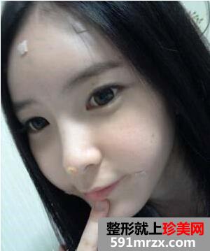 成都华博整形医院注射海薇玻尿酸半年了 快来看看效果