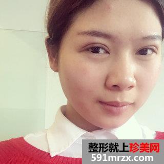 埋线双眼皮恢复图片经历分享 北京华韩埋线双眼皮