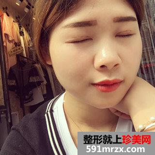 埋线双眼皮恢复图片经历分享 北京华韩埋线双眼皮
