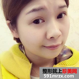 埋线双眼皮恢复图片经历分享 北京华韩埋线双眼皮