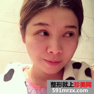 埋线双眼皮恢复图片经历分享 北京华韩埋线双眼皮