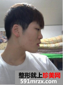 颧骨+下颚内缩+自体丰额头+埋线法双眼皮 术后的恢复经历