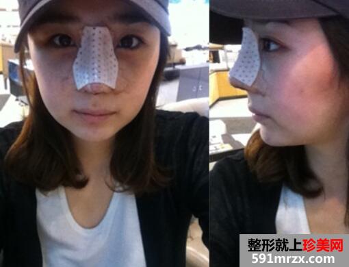 韩式生科三段假体隆鼻三个月恢复越来越好了