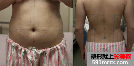 北京清木腰腹部吸脂恢复日记