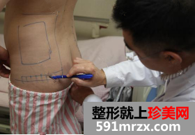 北京清木腰腹部吸脂恢复日记