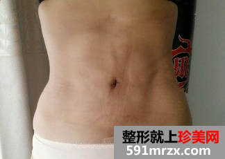 北京清木腰腹部吸脂恢复日记