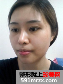割双眼皮+硅胶隆鼻+面部轮廓整形前后对比