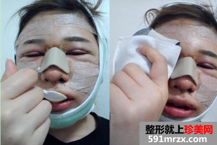 割双眼皮+硅胶隆鼻+面部轮廓整形前后对比