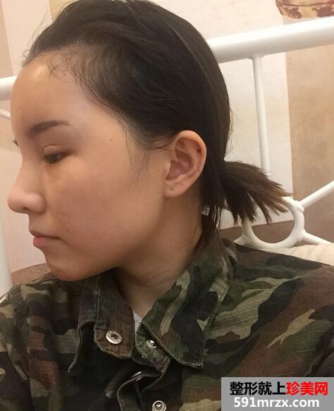 太阳穴额头脂肪填充，完成混血风蜕变【诗颜网】