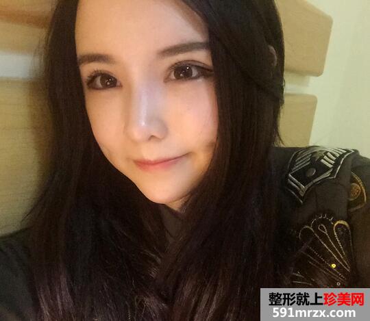 太阳穴额头脂肪填充，完成混血风蜕变【诗颜网】