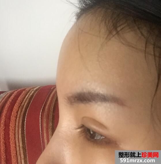 太阳穴额头脂肪填充，完成混血风蜕变【诗颜网】