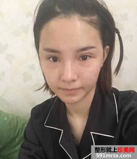 太阳穴额头脂肪填充，完成混血风蜕变【诗颜网】