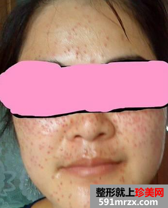 长春中研激光去斑前后对比