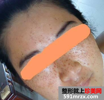 长春中研激光去斑前后对比