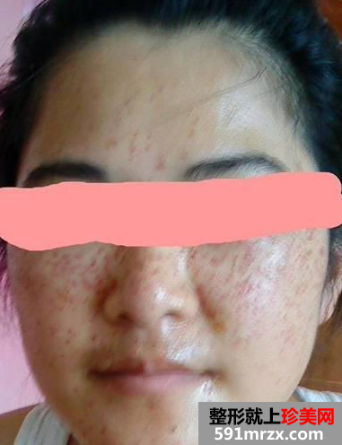 长春中研激光去斑前后对比