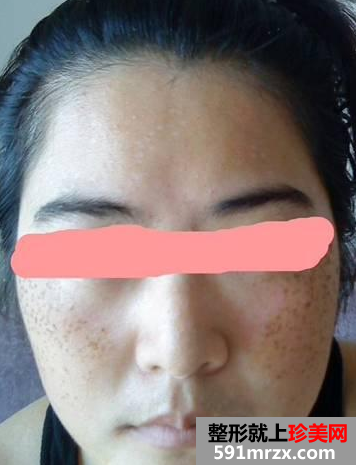 长春中研激光去斑前后对比