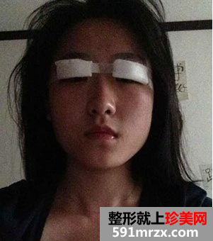 割双眼皮多久恢复自然 北京京美割双眼皮案例