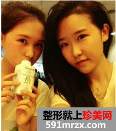 割双眼皮多久恢复自然 北京京美割双眼皮案例